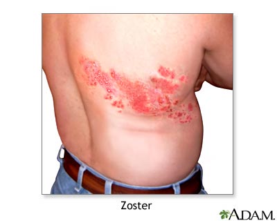Shingles Symptoms and Pictures