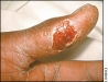 o_tularemia