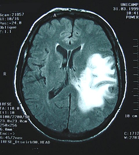 alteraciones y lesiones cerebrales