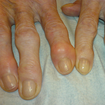 La artrosis es un efecto colateral de la lucha por la supervivencia del ser humano