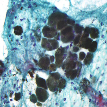 Micrografía de un melanoma. / Nephron (WIKIMEDIA)
