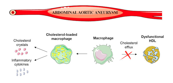Las lipoproteínas que transportan el colesterol 'bueno' pierden su capacidad cardioprotectora en pacientes con aneurisma aórtico abdominal. / CIBER
