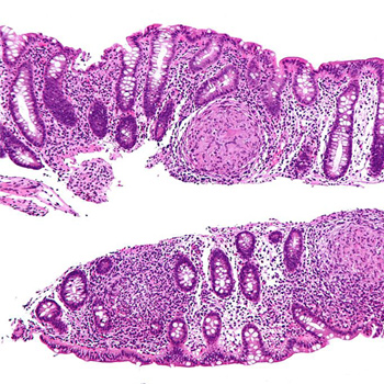 Micrografía de ampliación intermedia de la enfermedad de Crohn. Biopsia del colon. Mancha de H & E. / Nephron (WIKIMEDIA)