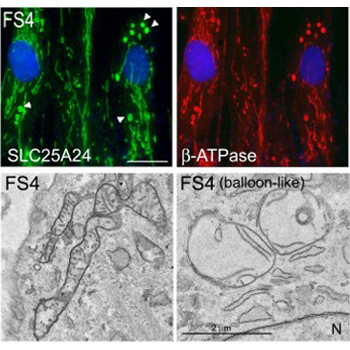 En fibroblastos de pacientes de síndrome de Fontaine (FSP) la presencia de la variante patogénica p.Arg217His de SCaMC-1/SLC25A24 altera la morfología mitocondrial. En estas células se detectan mitocondrias hinchadas cerca del núcleo, tanto mediante inmunofluorescencia utilizando anticuerpos contra proteínas mitocondriales como utilizando microscopia electrónica. Estas mitocondrias presentan crestas mitocondriales alteradas. / CIBERER