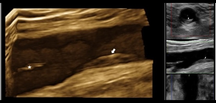 3D de la arteria femoral derecha. / CNIC