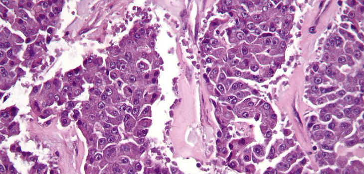 Micrografía de muy alta ampliación de un carcinoma de células acinares del páncreas. Tinción de H & E. / Nephron (WIKIMEDIA)