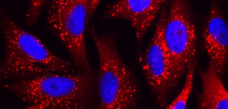 Identificación de nuevos moduladores de metástasis y mal pronóstico en el melanoma: Visualización de la proteína p62 (rojo) mediante microscopía de fluorescencia en células de melanoma. Las estructuras esféricas punteadas corresponden a grandes agregados de p62 con otras proteínas, entre ellas, factores que controlan múltiples procesos implicados en la supervivencia, proliferación e invasión de estas células tumorales. / CNIO