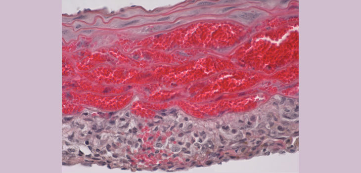 Imagen microscópica de hematoma intramural en el modelo preclínico de la enfermedad. / CSIC-CNIC