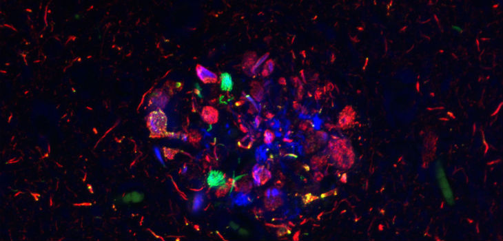 Imagen de una placa senil obtenida con microscopía láser confocal de la región CA1 del hipocampo de un paciente con enfermedad de Alzheimer. / CSIC