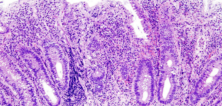 Imagen histopatológica de la etapa activa de la colitis ulcerosa. / KGH (WIKIMEDIA)