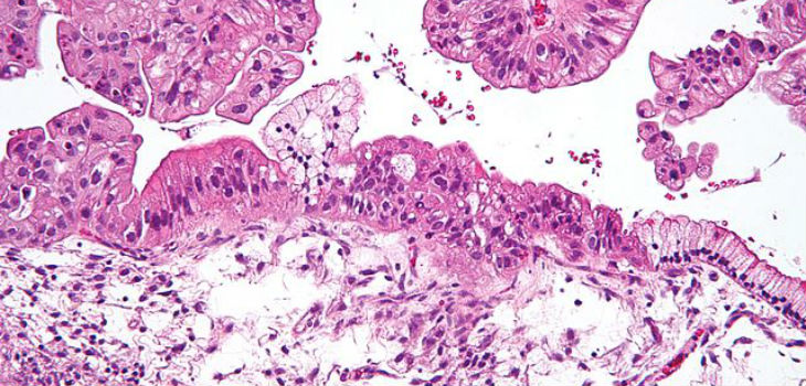 Micrografía de un tumor ovárico. / Nephron (WIKIMEDIA)