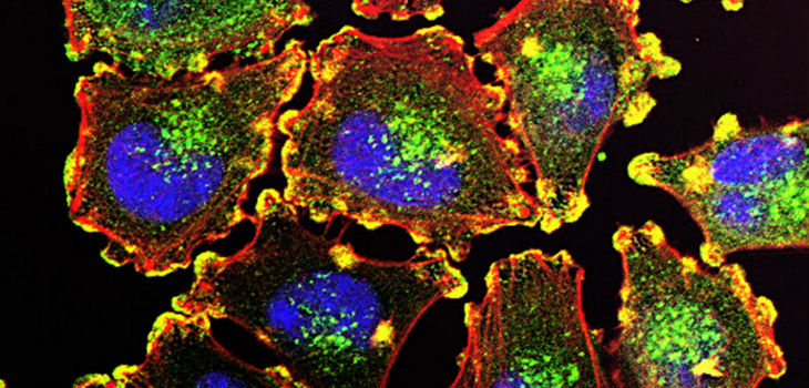 Células metastásicas del melanoma. / Julio C. Valencia, NCI Center for Cancer Research (FLICKR)