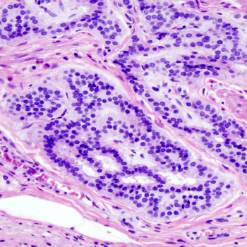 Imagen histopatológica de carcinoide de colon teñido con hematoxilina y eosina. / KGH (WIKIMEDIA)