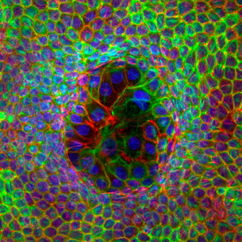 Imagen de células superdeformadas rodeadas por otras mínimamente deformadas. El núcleo celular se muestra en azul, los filamentos de actina en rojo y los filamentos de queratina en verde. / UPC-IBEC
