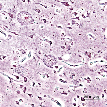 Imagen histopatológica de placas seniles vista en la corteza cerebral de un paciente con la enfermedad de Alzheimer. Impregnación con plata. / KGH (WIKIMEDIA)