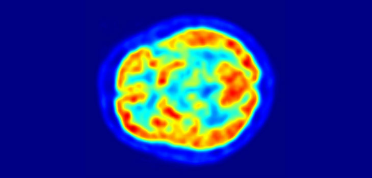Una tomografía por emisión de positrones con fluorodesoxiglucosa (18F) (FDG): áreas más calientes reflejan incremento en la captación de glucosa; y puede revelar actividad dopaminérgica mermada en los ganglios basales y facilitar el diagnóstico. / Jens Maus (WIKIMEDIA)