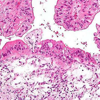 Tumor mucinoso de ovario visto bajo el microscopio, tinición HE. / Nephron (WIKIMEDIA)
