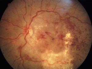 Imagen de retinopatía diabética no proliferativa. / Community Eye Health (FLICKR)