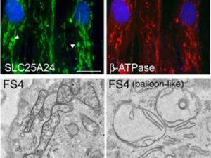 En fibroblastos de pacientes de síndrome de Fontaine (FSP) la presencia de la variante patogénica p.Arg217His de SCaMC-1/SLC25A24 altera la morfología mitocondrial. En estas células se detectan mitocondrias hinchadas cerca del núcleo, tanto mediante inmunofluorescencia utilizando anticuerpos contra proteínas mitocondriales como utilizando microscopia electrónica. Estas mitocondrias presentan crestas mitocondriales alteradas. / CIBERER