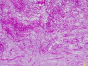 Tinción histológica de un corte de riñon infectado por candida donde se aprecian las hifas del hongo en forma de filamenos. / Ana Cuenda (CNB-CSIC)