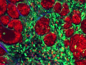 Imagen de los componentes de un tumor: en rojo, células cancerígenas; en verde, células "normales" (leucocitos, fibroblastos y células endoteliales); en azul, fibras de colágeno de la matriz extracelular. / IBBTEC