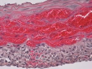 Imagen microscópica de hematoma intramural en el modelo preclínico de la enfermedad. / CSIC-CNIC