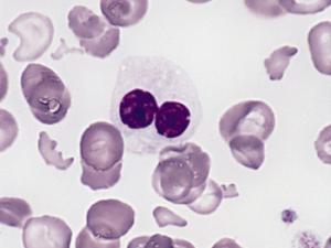 Frotis de sangre de una mujer adulta con síndrome mielodisplásico. / The Armed Forces Institute of Pathology-AFIP (WIKIMEDIA)