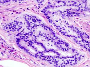 Imagen histopatológica de carcinoide de colon teñido con hematoxilina y eosina. / KGH (WIKIMEDIA)