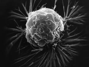 Celula cancerosa. / National Cancer Institute (Wikimedia Commons)