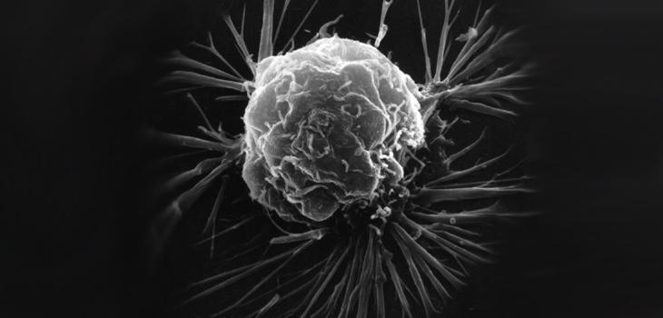 Celula cancerosa. / National Cancer Institute (Wikimedia Commons)