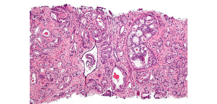 Micrografía que muestra adenocarcinoma acinar prostático (la forma más común de cáncer de próstata) patrón de Gleason 4. Tinción de H & E. / Nephron (WIKIMEDIA)
