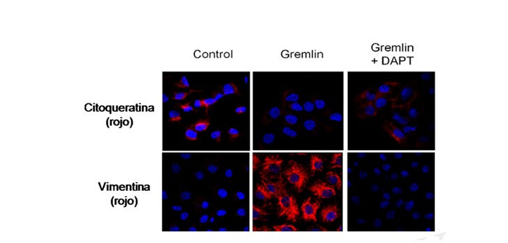 Células marcadas con fluorescencia. Azul: núcleos. Rojo: Vimentina Control: Células sanas. Gremlin: células tratadas con Gremlin en el medio de cultivo. Gremlin + DAPT: Células con Gremlin y el fármaco experimental que limita su actividad (DAPT). / UAM