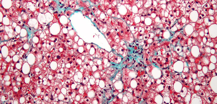 Micrografía de la enfermedad del hígado graso no alcohólico. / Nephron (WIKIMEDIA)