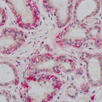 Científicos emplean por primera vez microgeles desarrollados sobre oro esférico para mejorar el tratamiento de cáncer de mama
