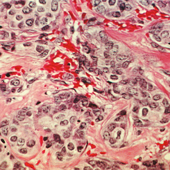Células de cáncer de mama. / Dr. Cecil Fox (Photographer), National Cancer Institute, National Institutes of Health (FLICKR)