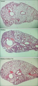Corte histológico de fibrosis pulmonar