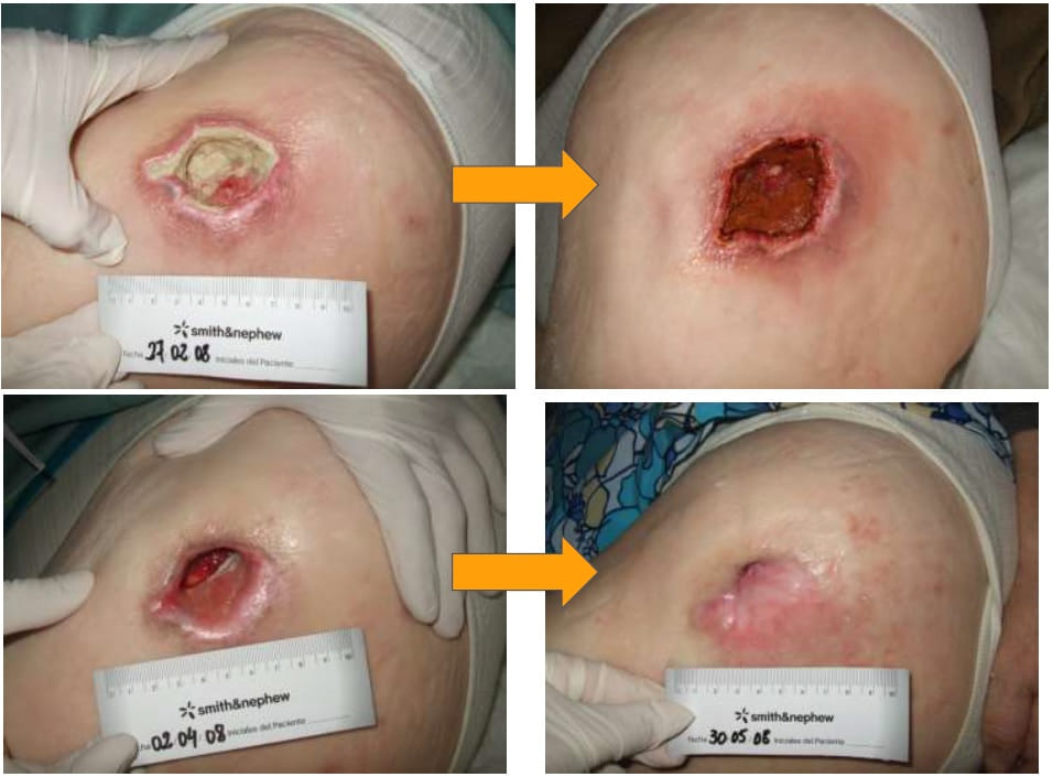 Buena evolución en 3 meses de úlcera cavitada en trocánter