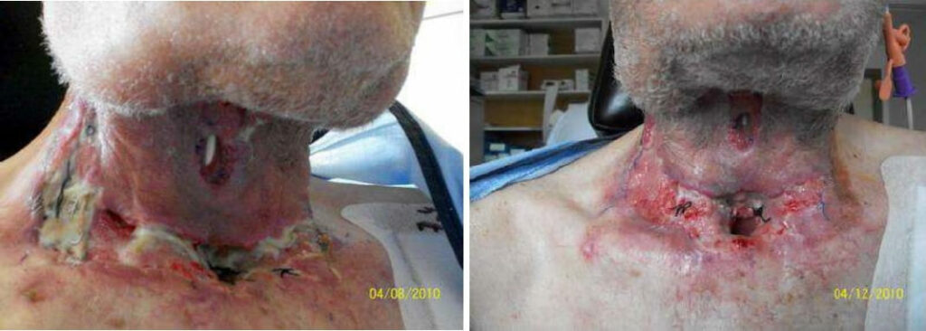 Heridas postquirúrgicas con mala evolución. Gran limpieza en 2 curas