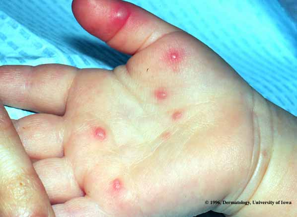 Enfermedad mano, pie, boca por Enterovirus E-V71, Estomatitis vesicular con - Salud Pública y algo más