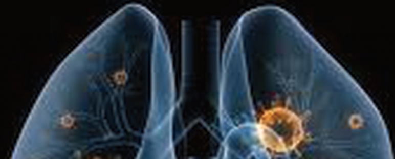 Mejora en el tratamiento del cáncer de pulmón