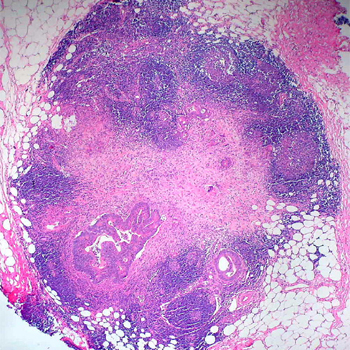 Ganglio paracolónico de un espécimen de colectomía de una mujer de 61 años con un tumor obstructivo de colon sigmoide. / Ed Uthman (FLICKR)
