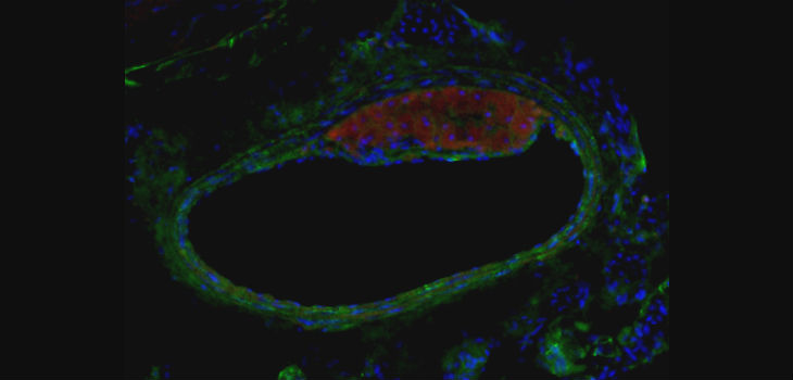 Detección de inmunofluorescencia de una placa de aterosclerosis en arteria carótida (verde: células musculares lisas; rojo: macrófagos o células espumosas; azul: núcleos) / MARIO DELGADO