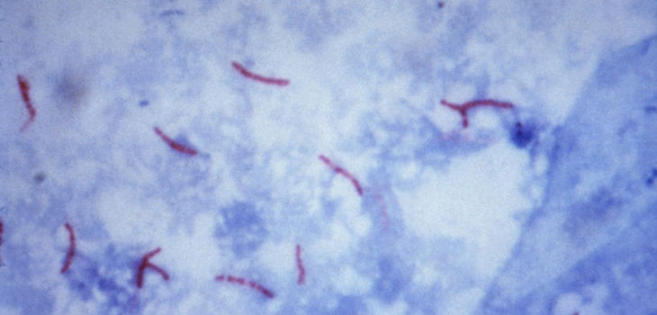 La bacteria Mycobacterium tuberculosis en el esputo de un paciente, visualizada con la tinción de Ziehl-Neelsen. /CSIC