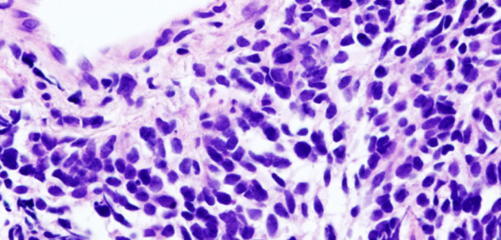 Imagen histopatológica del carcinoma de células pequeñas del pulmón. Biopsia con aguja gruesa guiada por TC. Tinción de H & E. / KGH (PIXABAY)