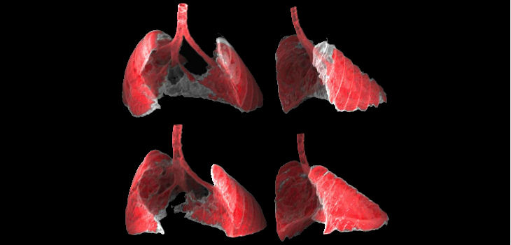 La figura muestra dos vistas, frontal y lateral, de la imagen obtenida por TAC de los pulmones de un ratón con fibrosis (zonas grises) antes y después de ser tratado con nanoterapia dirigida a las células senescentes. / G Garaulet i F Mulero, CNIO