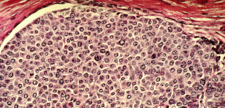 Células cáncer de mama. / Dr. Cecil Fox (WIKIMEDIA)