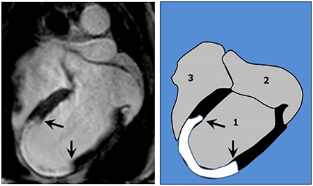 Descifran el mecanismo por el que un fármaco conocido hace décadas reduce el tamaño del infarto