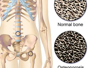 Hallan una mutación que debilita los huesos con los fármacos para la osteoporosis