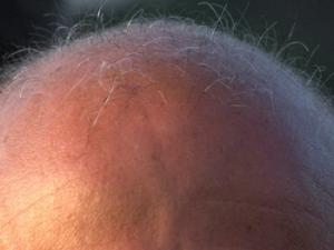 Hallan una nueva vía prometedora para prevenir y revertir la calvicie