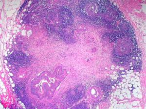 Ganglio paracolónico de un espécimen de colectomía de una mujer de 61 años con un tumor obstructivo de colon sigmoide. / Ed Uthman (FLICKR)